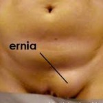 ernia